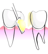ＣＲ接着修復法の奥歯を補うしくみ02