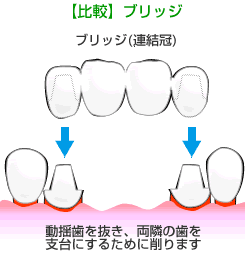 ブリッジ治療との比較
