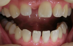前歯一本をつくる治療の例　治療前