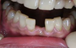 前歯をつくる治療の例　治療前