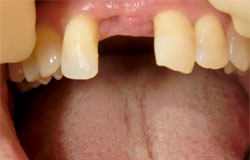 前歯をつくる治療の例　治療前