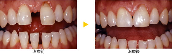 前歯の大きな隙間もきれいに修復