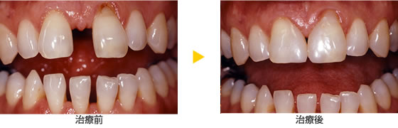 歯の隙間をふさぐ