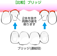 ブリッジ治療との比較