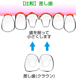 差し歯との比較