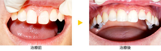 １回の治療で自然な仕上がり