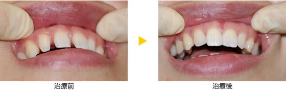 就職活動の前に歯の隙間を修復
