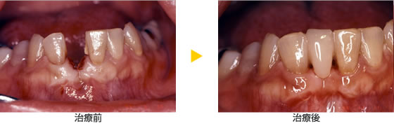 抜けた前歯をつくる