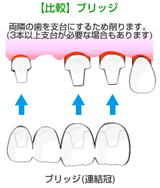 通常のブリッジ治療との比較