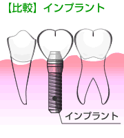 インプラント治療との比較