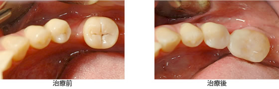 抜けた奥歯を補う