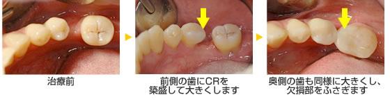 両隣の歯を大きくして抜けた奥歯を補う