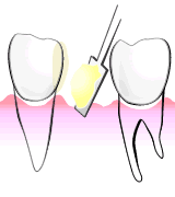 ＣＲ接着修復法の奥歯を補うしくみ01