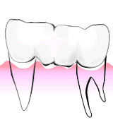 ＣＲ接着修復法の奥歯を補うしくみ03