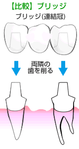 ブリッジ治療との比較