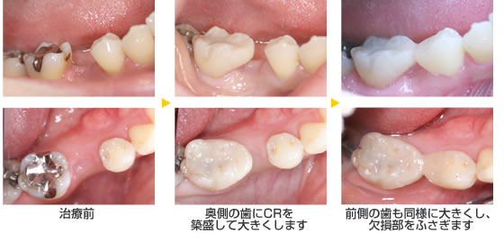奥歯 抜け た 治療