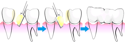 当院のＣＲ接着修復法
