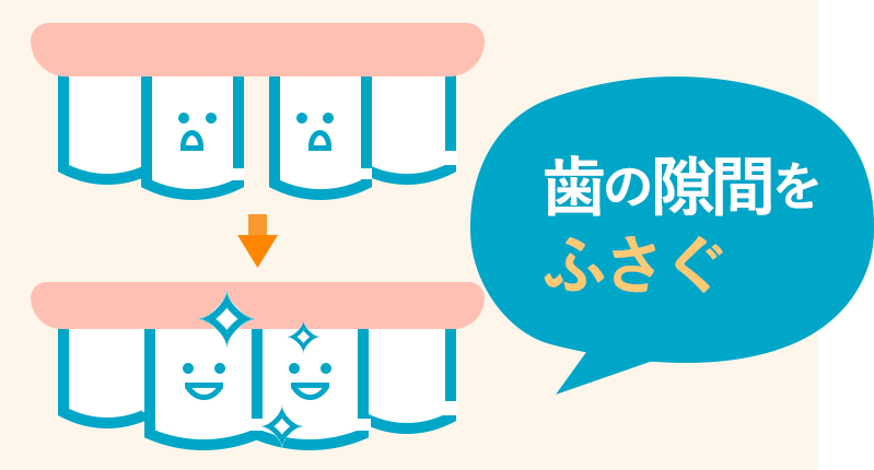 CR接着修復法で前歯の隙間を埋める治療の例