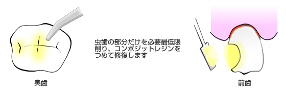 コンポジットレジン修復で削らず治す