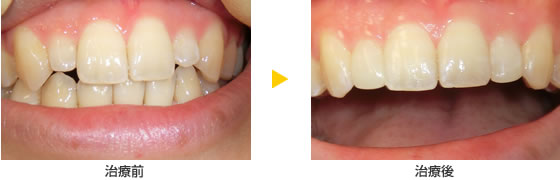 CR接着修復法で前歯の形を変える治療の例