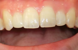 前歯の形を変える治療の例　治療後