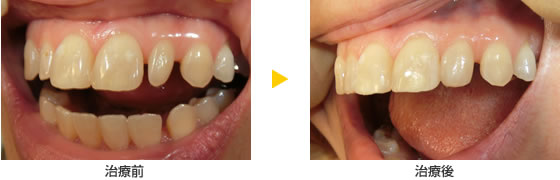 CR接着修復法で歯の形を変えて隙間をなくす治療の例