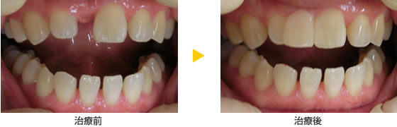 CR接着修復法で前歯一本をつくる治療の例