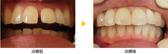 CR接着修復法で前歯の隙間を埋める治療の例