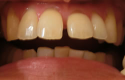前歯の隙間を埋める治療治療の例　治療前