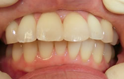 前歯の隙間を埋める治療の例　治療後