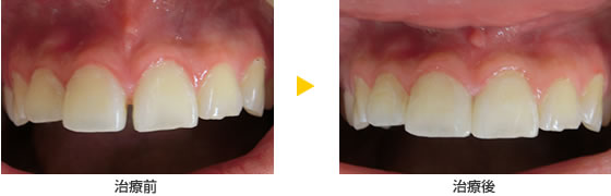 CR接着修復法で前歯の隙間を埋める治療の例