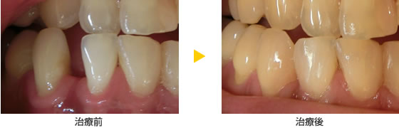 CR接着修復法による前歯の隙間の治療例