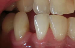 前歯の隙間の治療の例　治療前