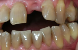CR接着修復法で前歯一本をつくる治療の例　治療前