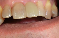 前歯一本をつくる治療の例　治療後