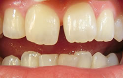 CR接着修復法で前歯の隙間を埋める治療の例　治療前