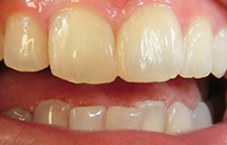 CR接着修復法で前歯の隙間を埋める治療の例　治療後