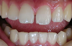 前歯の隙間を埋める治療の例　治療前