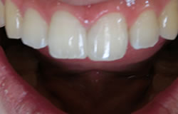 前歯の隙間を埋める治療の例　治療後