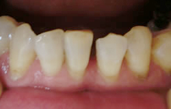 CR接着修復法で前歯の隙間を埋める治療の例　治療前