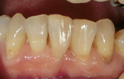 CR接着修復法で前歯の隙間を埋める治療の例　治療後