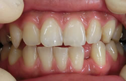 CR接着修復法で前歯をつくる治療の例　治療前
