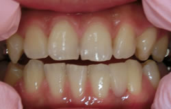CR接着修復法で前歯をつくる治療の例　治療後