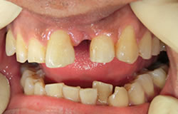 CR接着修復法で前歯をつくる治療の例　治療前