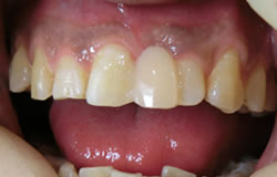 CR接着修復法で前歯をつくる治療の例　治療後