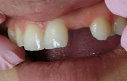 前歯をつくる治療例　治療前