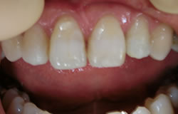 前歯の隙間の治療の例　治療前