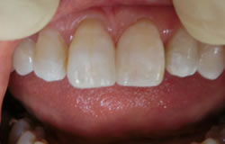 前歯の隙間の治療の例　治療後