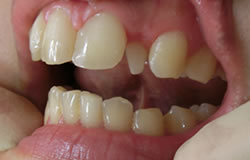 前歯の形を変える治療の例　治療前