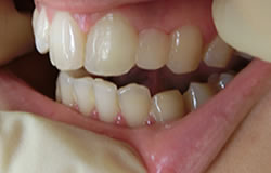 前歯の形を変える治療の例　治療後